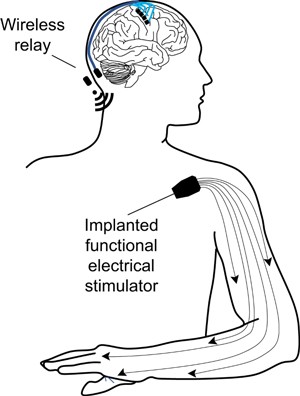 Sensors implanted within or adjacent to perilesional motor cortices relay signals wirelessly to microprocessors that decode motor intent that in turn triggers a functional electrical stimulation system implanted within the paretic limb to restore voluntary motor function.